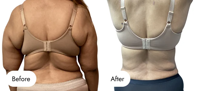 before-after-img-11