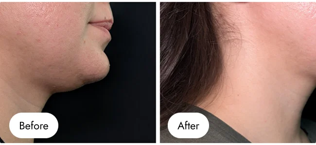 before-after-img-16